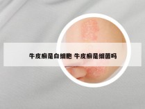 牛皮癣是白细胞 牛皮癣是细菌吗