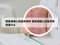 银屑病病人的指甲表现 银屑病病人的指甲表现是什么