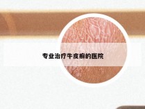 专业治疗牛皮癣的医院