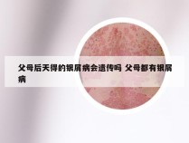 父母后天得的银屑病会遗传吗 父母都有银屑病