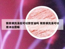 银屑病洗澡后可以擦甘油吗 银屑病洗澡可以用沐浴露嘛