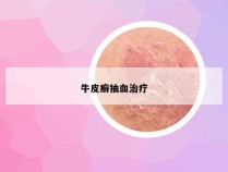 牛皮癣抽血治疗