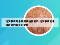 吃海参有助于银屑病的恢复吗 吃海参有助于银屑病的恢复吗女性
