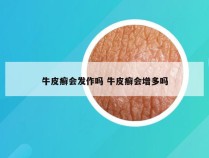 牛皮癣会发作吗 牛皮癣会增多吗