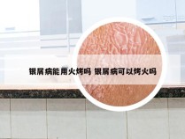 银屑病能用火烤吗 银屑病可以烤火吗
