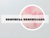 银屑病早期好治么 银屑病早期可以治愈吗