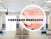 牛皮癣芋头能吃吗 银屑病可以吃芋头