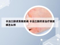 卡泊三醇诱发银屑病 卡泊三醇药膏治疗银屑病怎么样