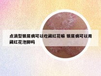 点滴型银屑病可以吃藏红花嘛 银屑病可以用藏红花泡脚吗