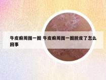 牛皮癣周围一圈 牛皮癣周围一圈脱皮了怎么回事