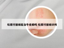 松原付丽娟能治牛皮癣吗 松原付丽娟诊所