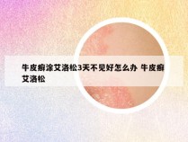 牛皮癣涂艾洛松3天不见好怎么办 牛皮癣 艾洛松