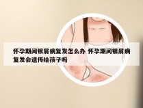 怀孕期间银屑病复发怎么办 怀孕期间银屑病复发会遗传给孩子吗