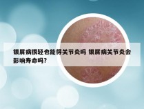 银屑病很轻也能得关节炎吗 银屑病关节炎会影响寿命吗?
