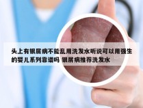头上有银屑病不能乱用洗发水听说可以用强生的婴儿系列靠谱吗 银屑病推荐洗发水