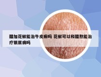 醋加花椒能治牛皮癣吗 花椒可以和醋熬能治疗银屑病吗