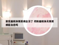 割完扁桃体银屑病全没了 切除扁桃体炎银屑病能治愈吗