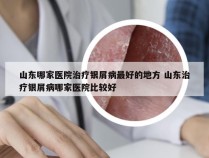山东哪家医院治疗银屑病最好的地方 山东治疗银屑病哪家医院比较好