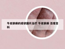 牛皮肤癣的症状图片治疗 牛皮肤癣 百度百科