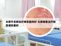 太原牛皮癣治疗哪家医院好 太原哪里治疗银屑病效果好