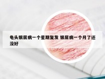 龟头银屑病一个星期复发 银屑病一个月了还没好