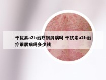 干扰素a2b治疗银屑病吗 干扰素a2b治疗银屑病吗多少钱