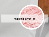 牛皮癣哪里治疗好一些