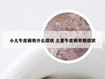 小儿牛皮癣有什么症状 儿童牛皮癣早期症状