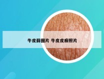 牛皮藓图片 牛皮皮癣照片