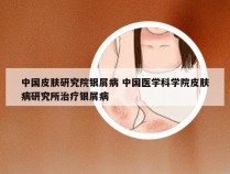中国皮肤研究院银屑病 中国医学科学院皮肤病研究所治疗银屑病