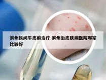 滨州民间牛皮癣治疗 滨州治皮肤病医院哪家比较好