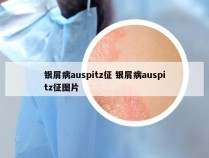 银屑病auspitz征 银屑病auspitz征图片