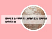 福州哪里治疗银屑病比较好的医院 福州专业治疗皮肤病