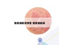 银屑病新浪博客 银屑病新闻