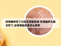 玫瑰糠疹好了以后又得银屑病 玫瑰糠疹大部分好了,还有新起的是怎么回事