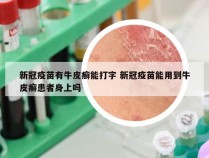 新冠疫苗有牛皮癣能打字 新冠疫苗能用到牛皮癣患者身上吗