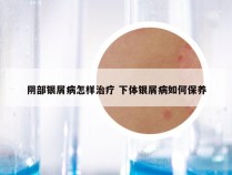 阴部银屑病怎样治疗 下体银屑病如何保养