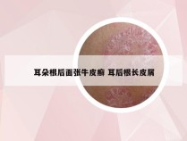 耳朵根后面张牛皮癣 耳后根长皮屑