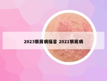 2023银屑病福音 2021银屑病