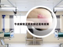 牛皮癣变正常皮肤还是有皮屑