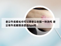 老公牛皮癣毛巾可以跟老公衣服一块洗吗 老公有牛皮廨我会感染hpv吗