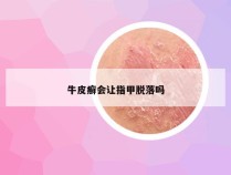 牛皮癣会让指甲脱落吗