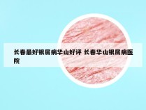长春最好银屑病华山好评 长春华山银屑病医院