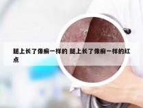 腿上长了像癣一样的 腿上长了像癣一样的红点