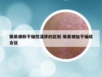 银屑病和干燥性湿疹的区别 银屑病加干燥综合征
