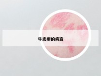 牛皮癣的病变