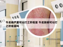 牛皮癣严重可以打乙肝疫苗 牛皮肤癣可以打乙肝疫苗吗