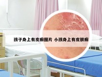 孩子身上有皮癣图片 小孩身上有皮肤癣
