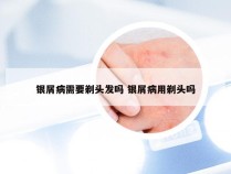 银屑病需要剃头发吗 银屑病用剃头吗