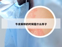 牛皮癣样的时候是什么样子